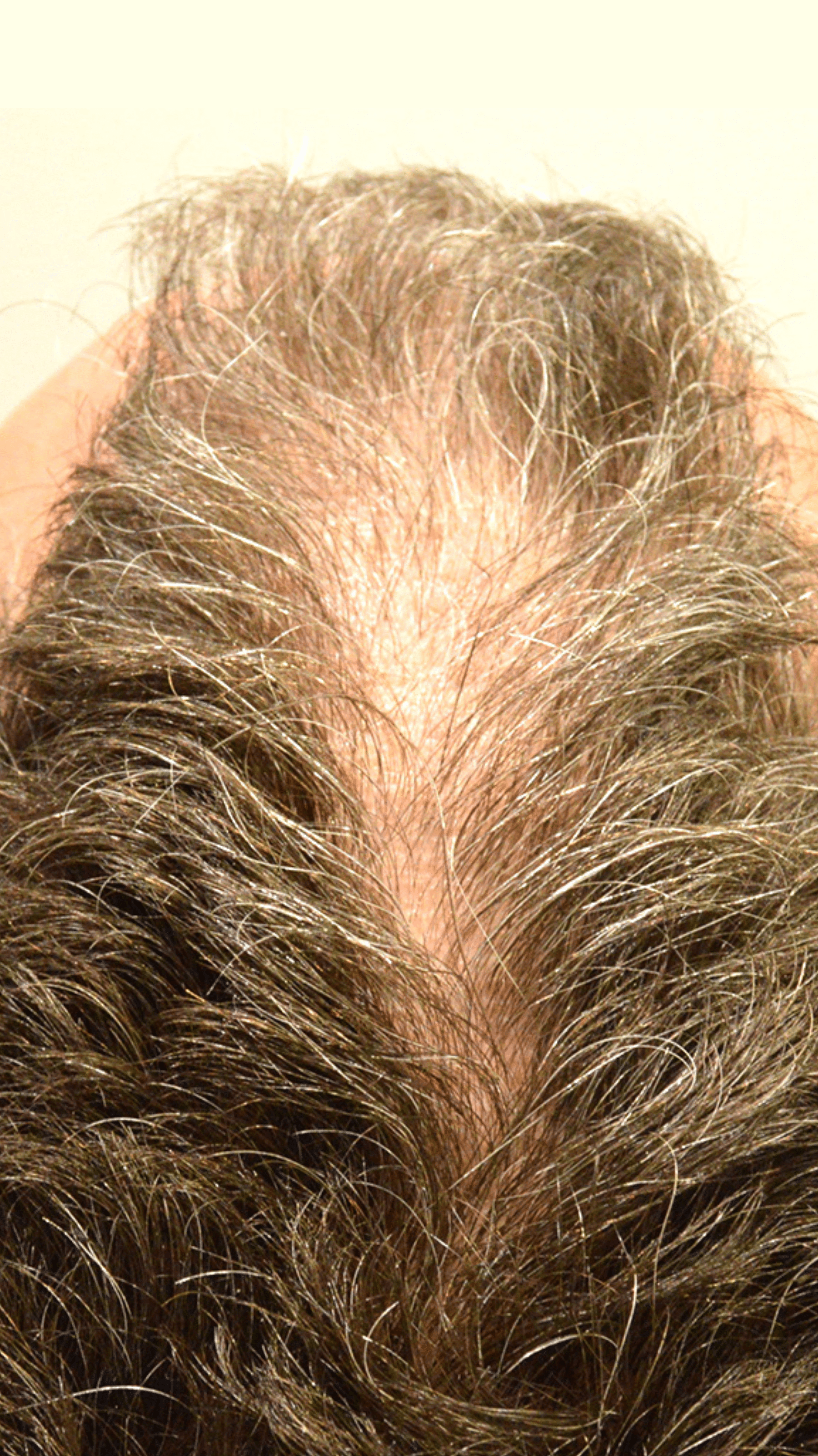Close-up of a person's scalp with thinning hair.